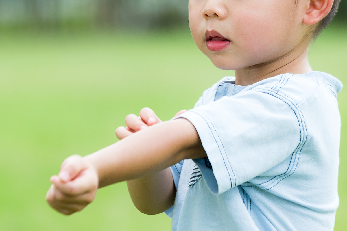 Cara Mengobati Biduran pada Anak Secara Alami